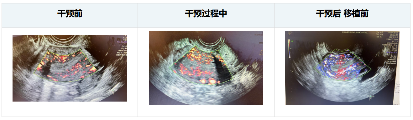 干预前、干预过程中和移植前的三幅子宫彩色多普勒超声原始对照图