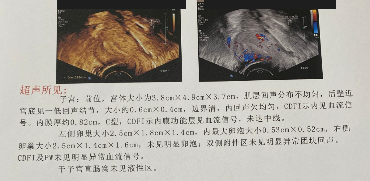 移植前子宫超声脱敏截取，内膜厚约0.82cm，C型，CDFI提示内膜功能层见血流信号但未达中线